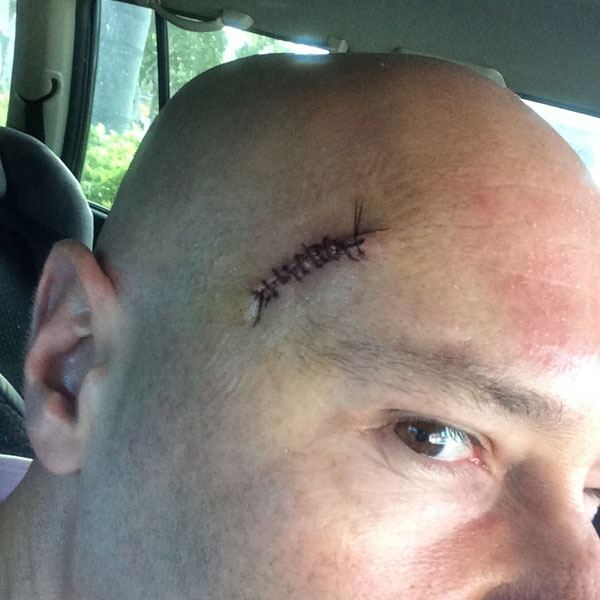 Stitches post SCC 
removal